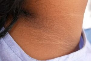 insulin resistance symptoms